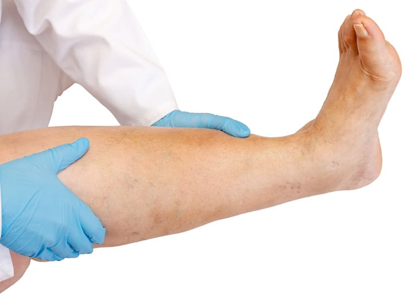 tratamiento trombosis